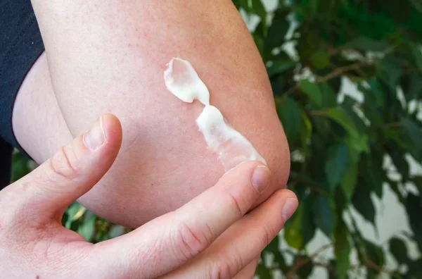 Top Home Remedies to Soothe Bed Bug Bite Discomfort