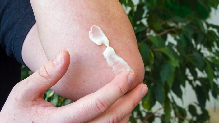 Top Home Remedies to Soothe Bed Bug Bite Discomfort